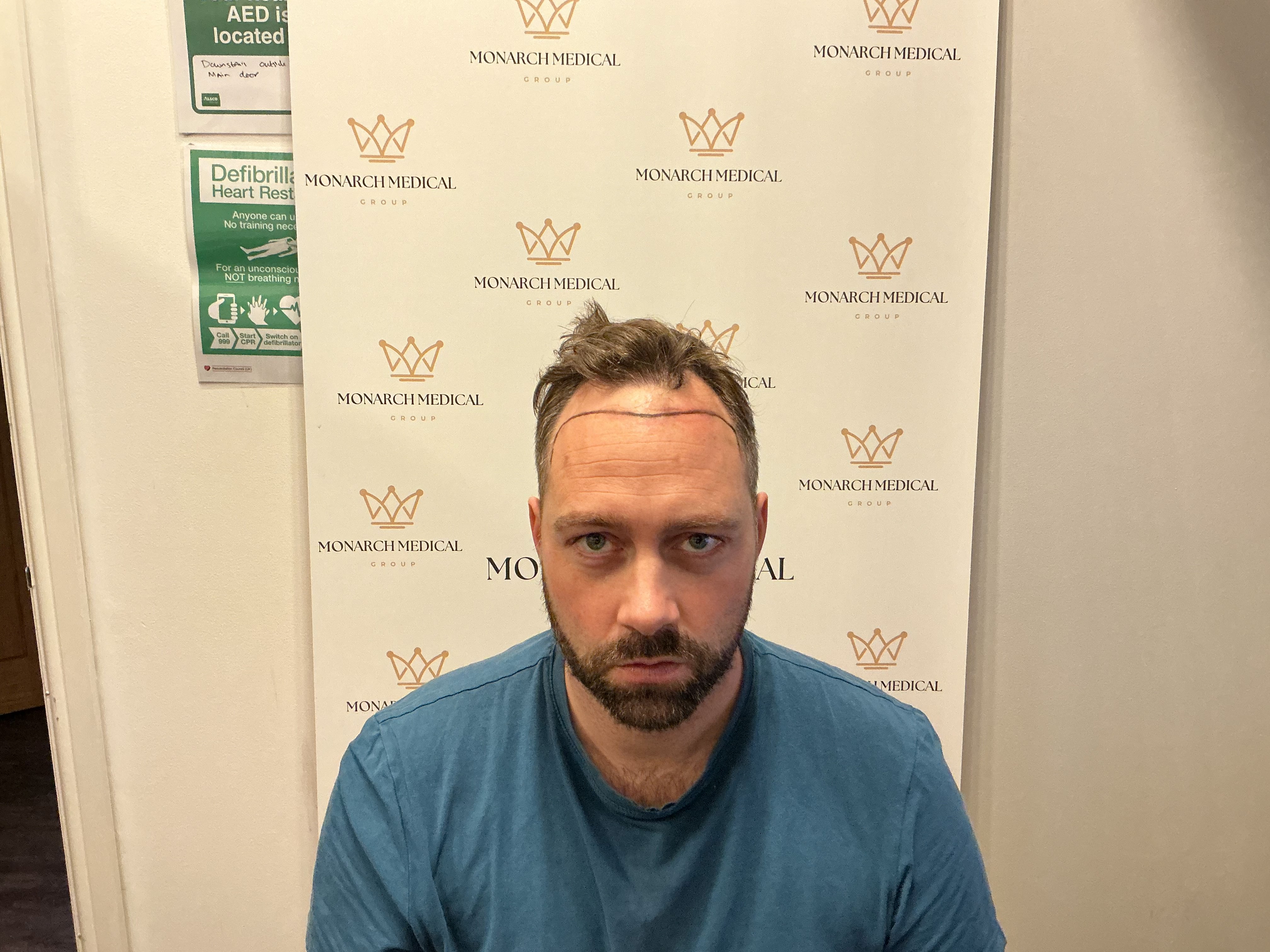 Hairline Restoration