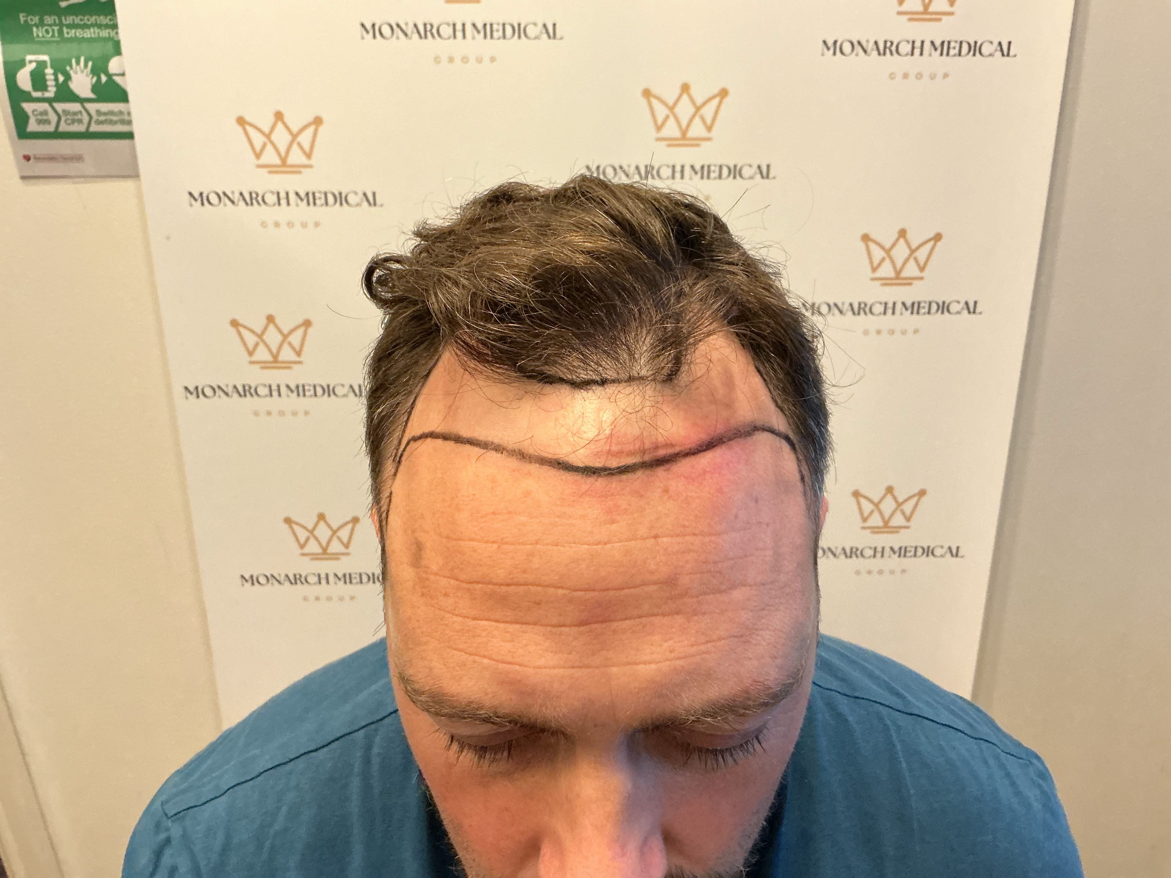 Hairline detail view