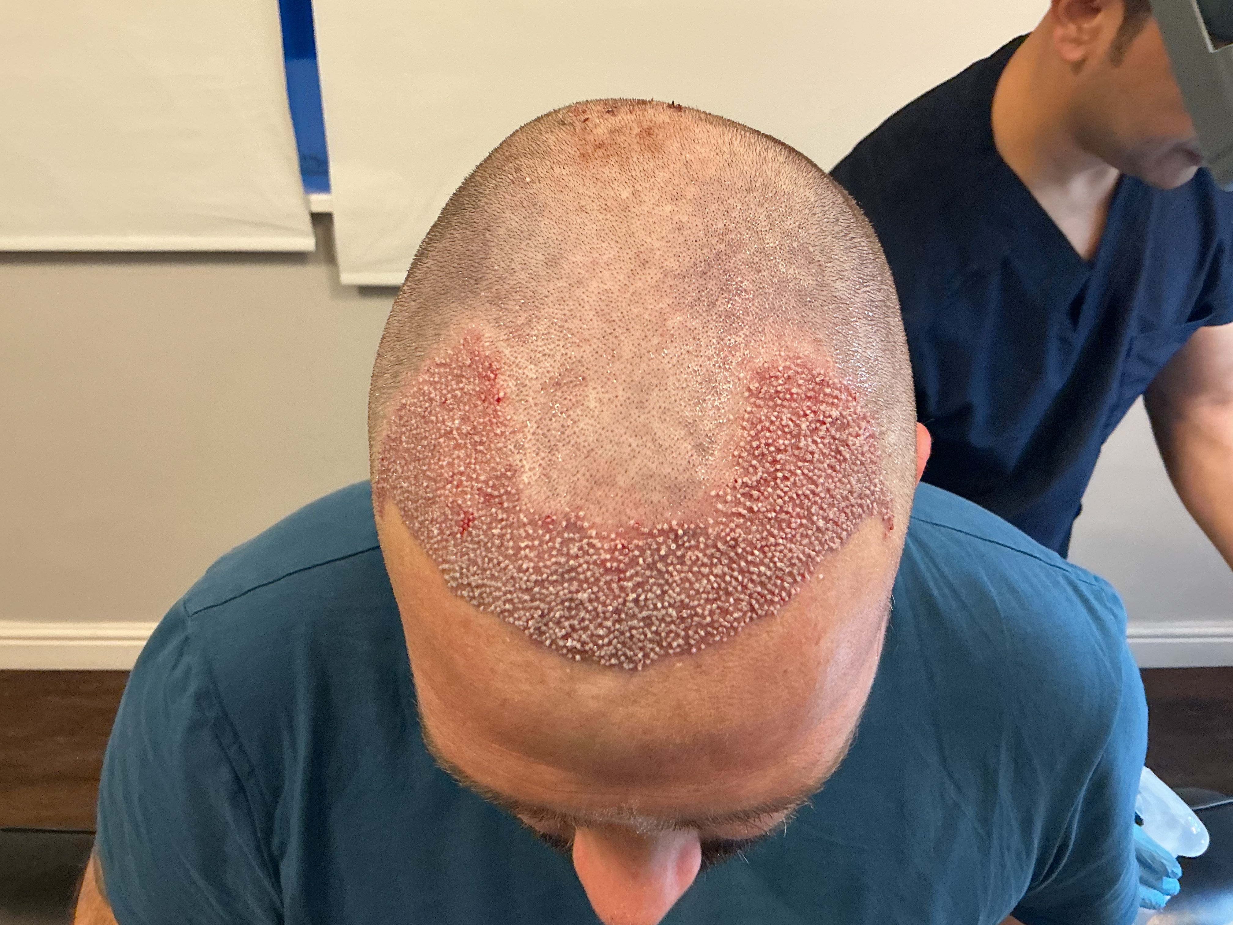Frontal hairline result