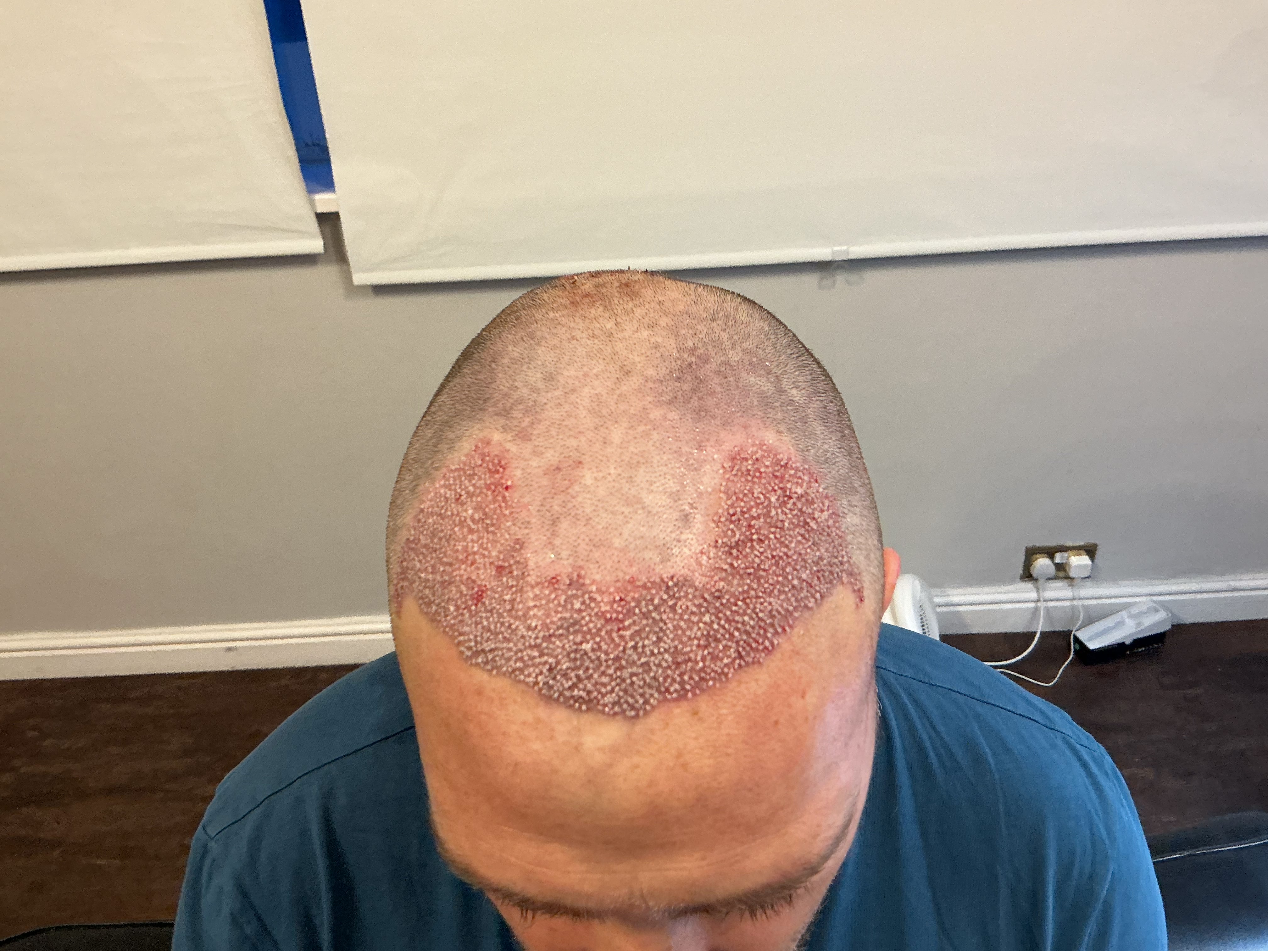 Hairline density view