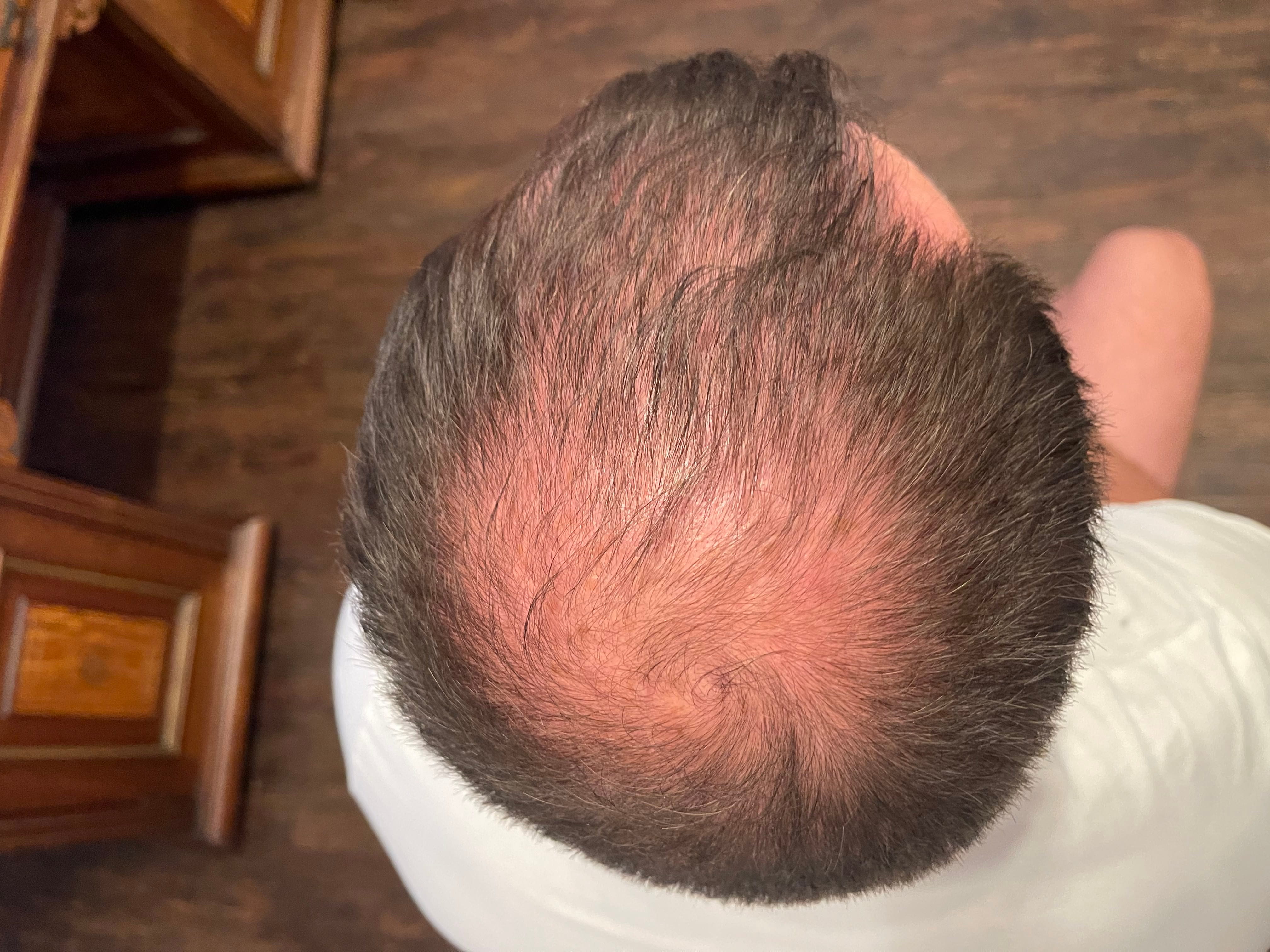 Hairline and temple reconstruction result