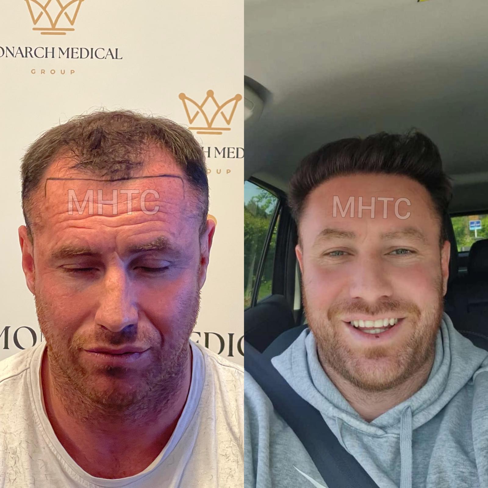 Before and after comparison
