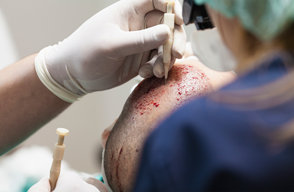 DHI Hair Transplant