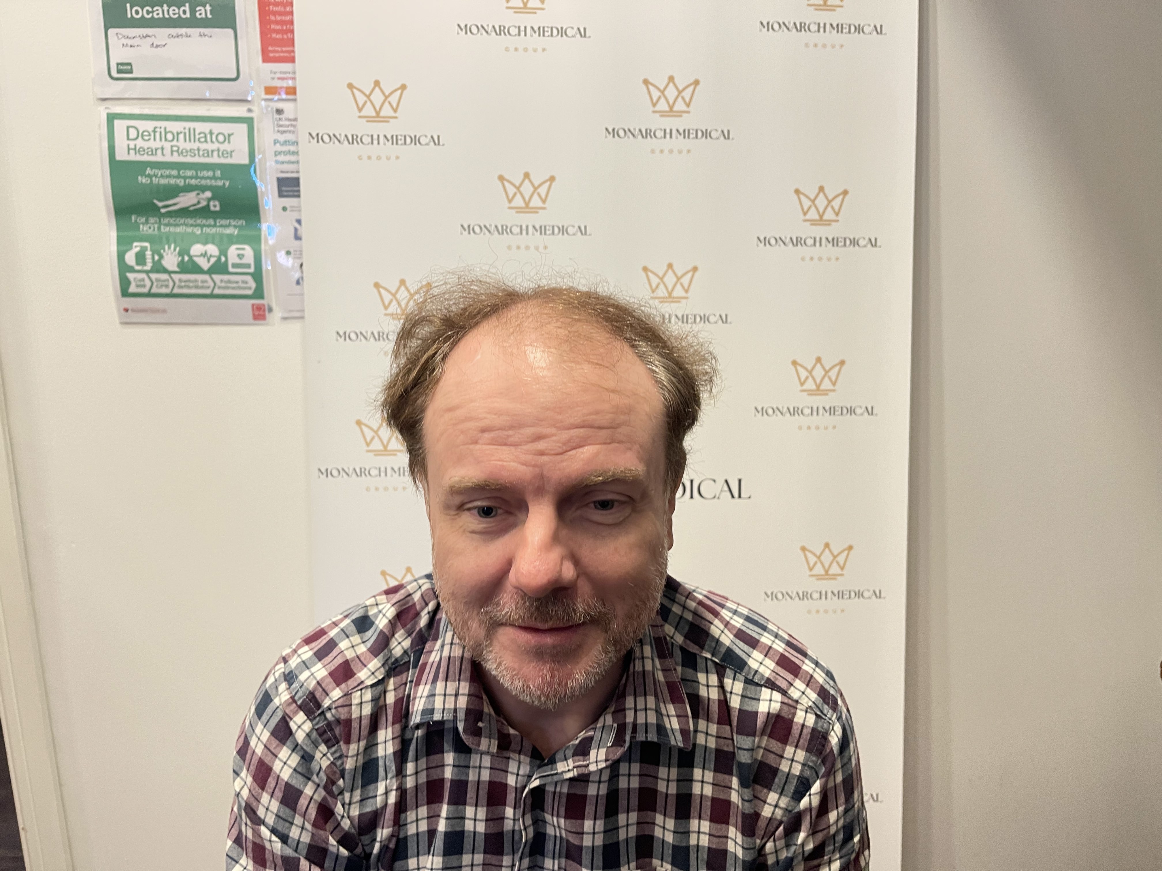 Full scalp hair restoration result photo 1