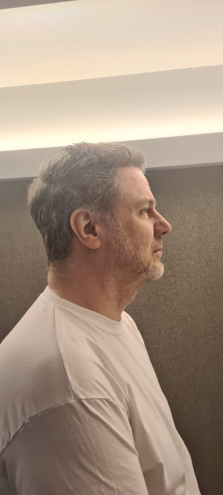 Full scalp hair restoration result photo 10