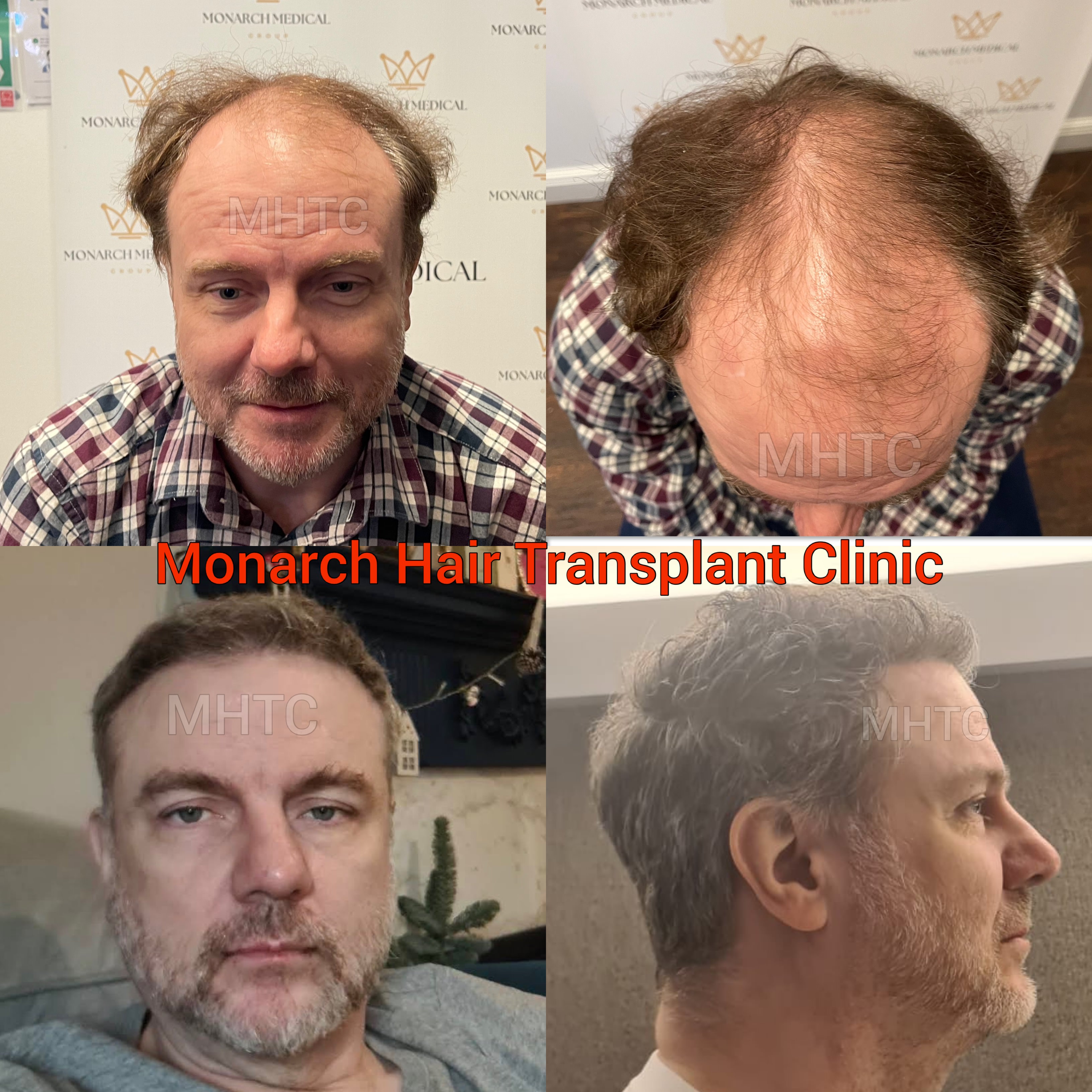 Full scalp hair restoration result photo 12