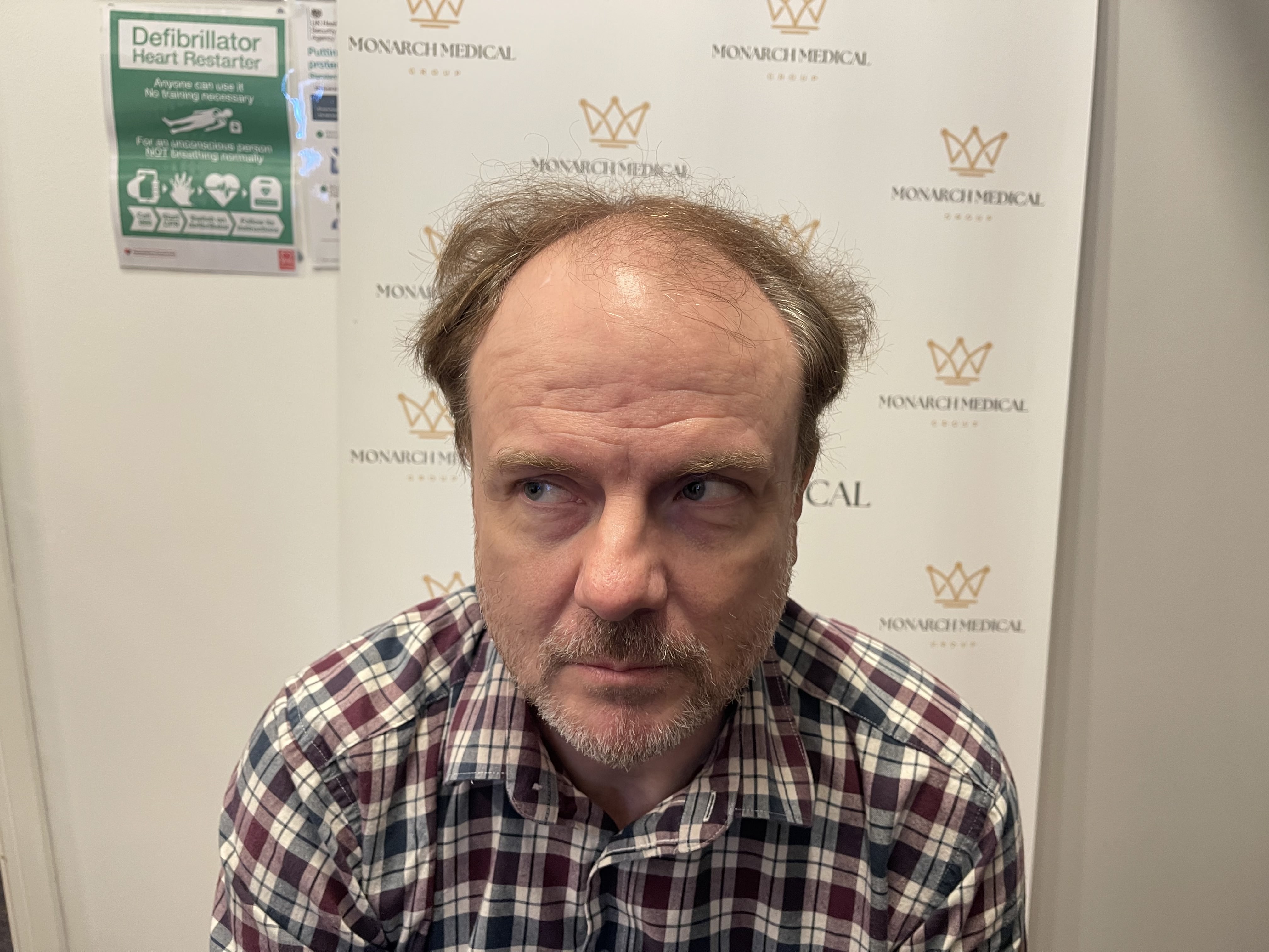 Full scalp hair restoration result photo 2