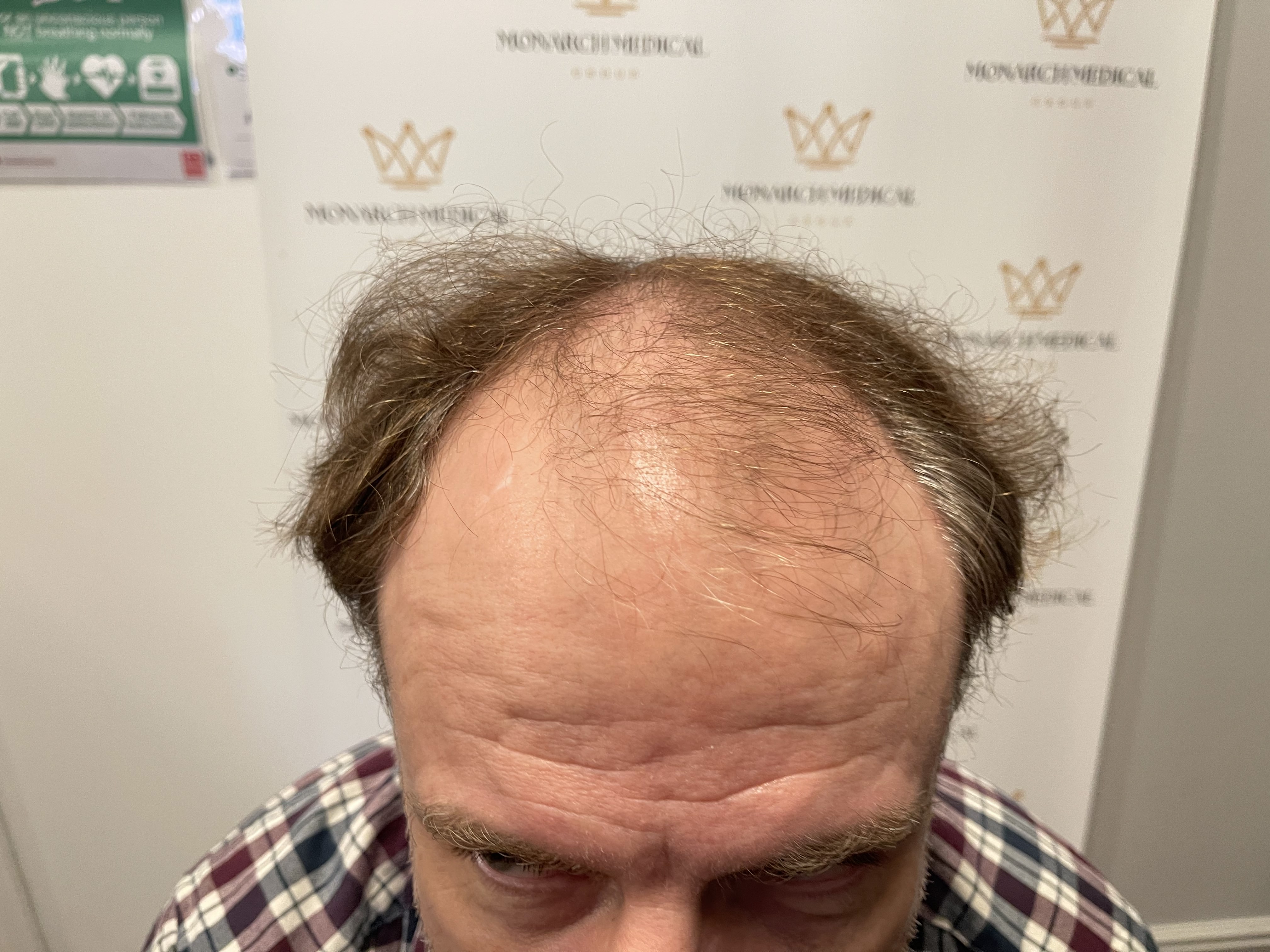 Full scalp hair restoration result photo 3