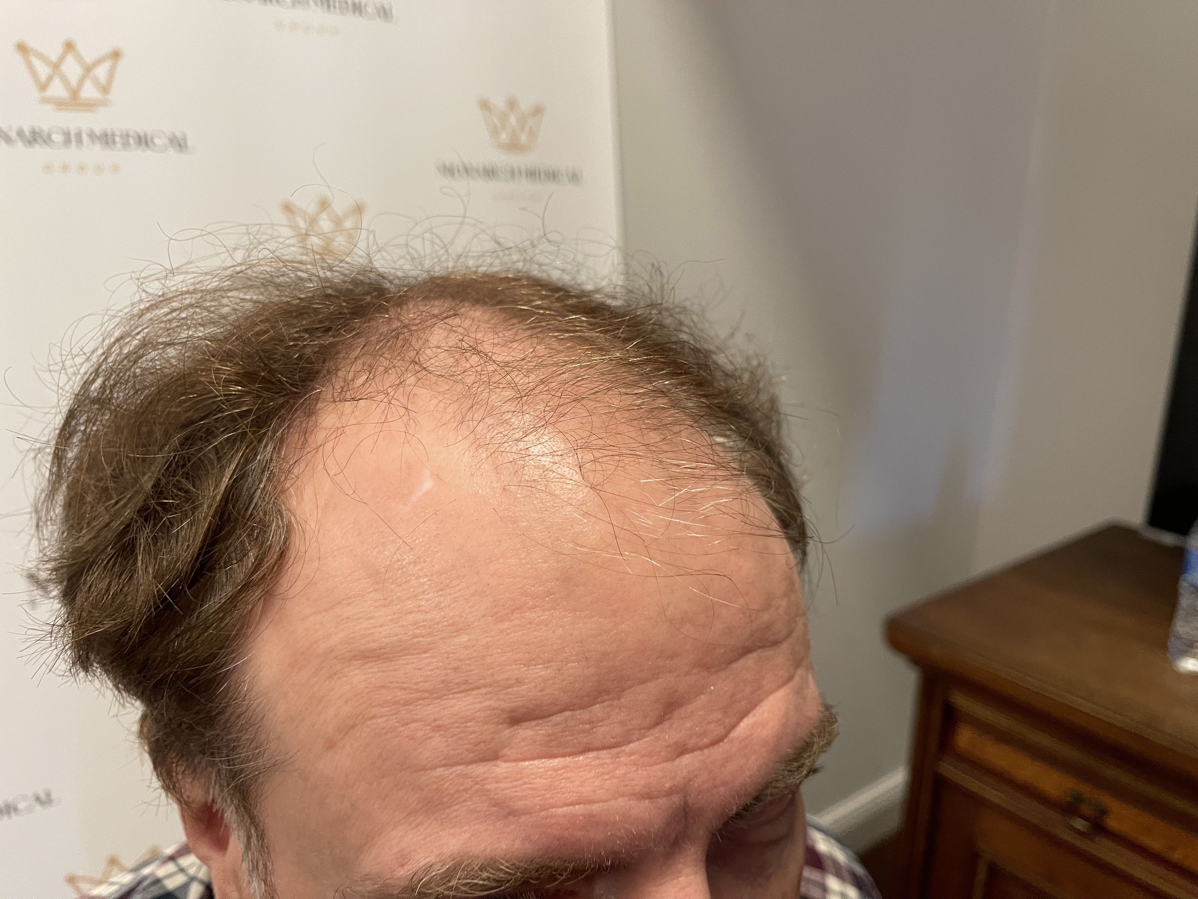 Full scalp hair restoration result photo 4