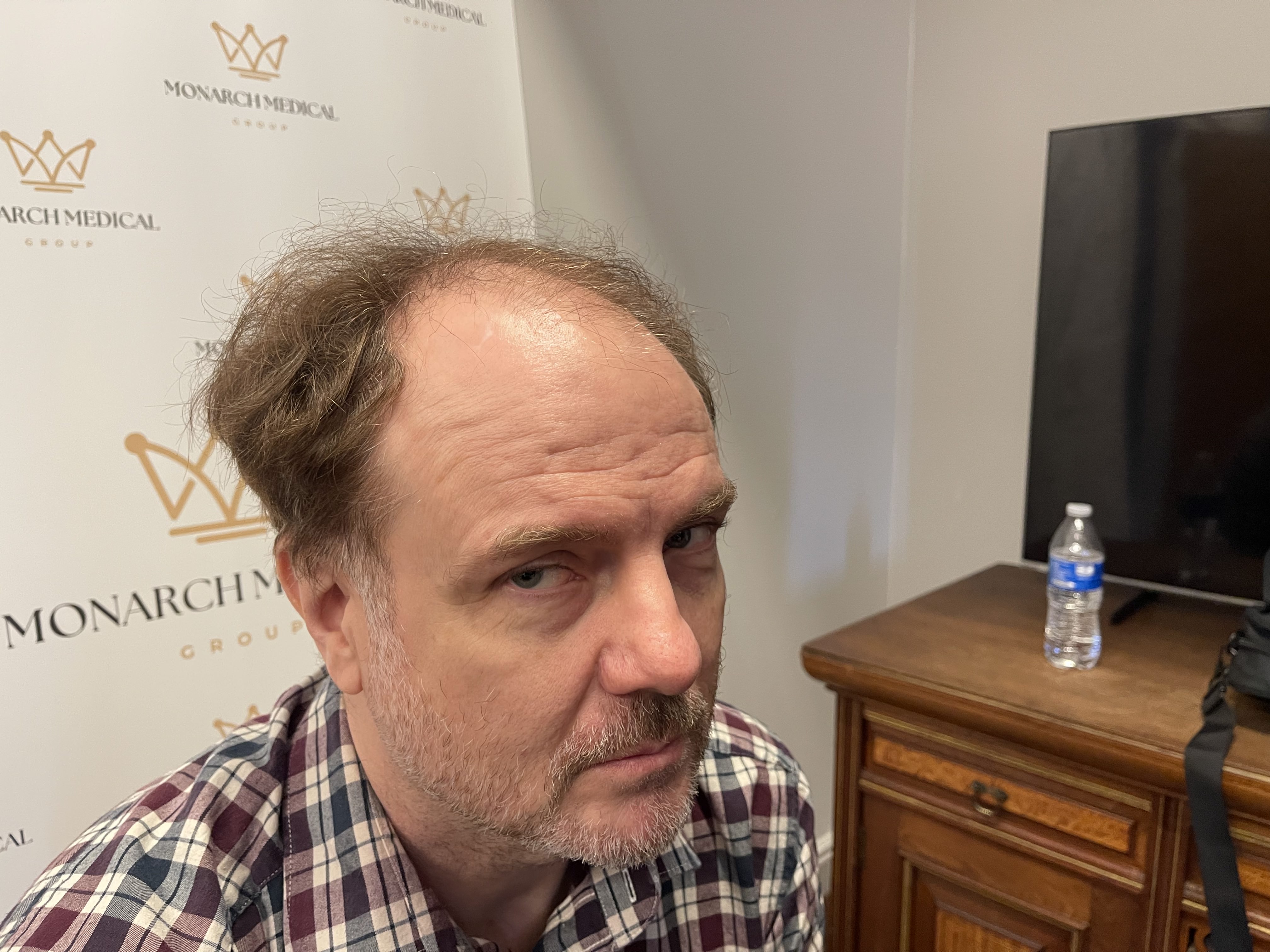 Full scalp hair restoration result photo 5