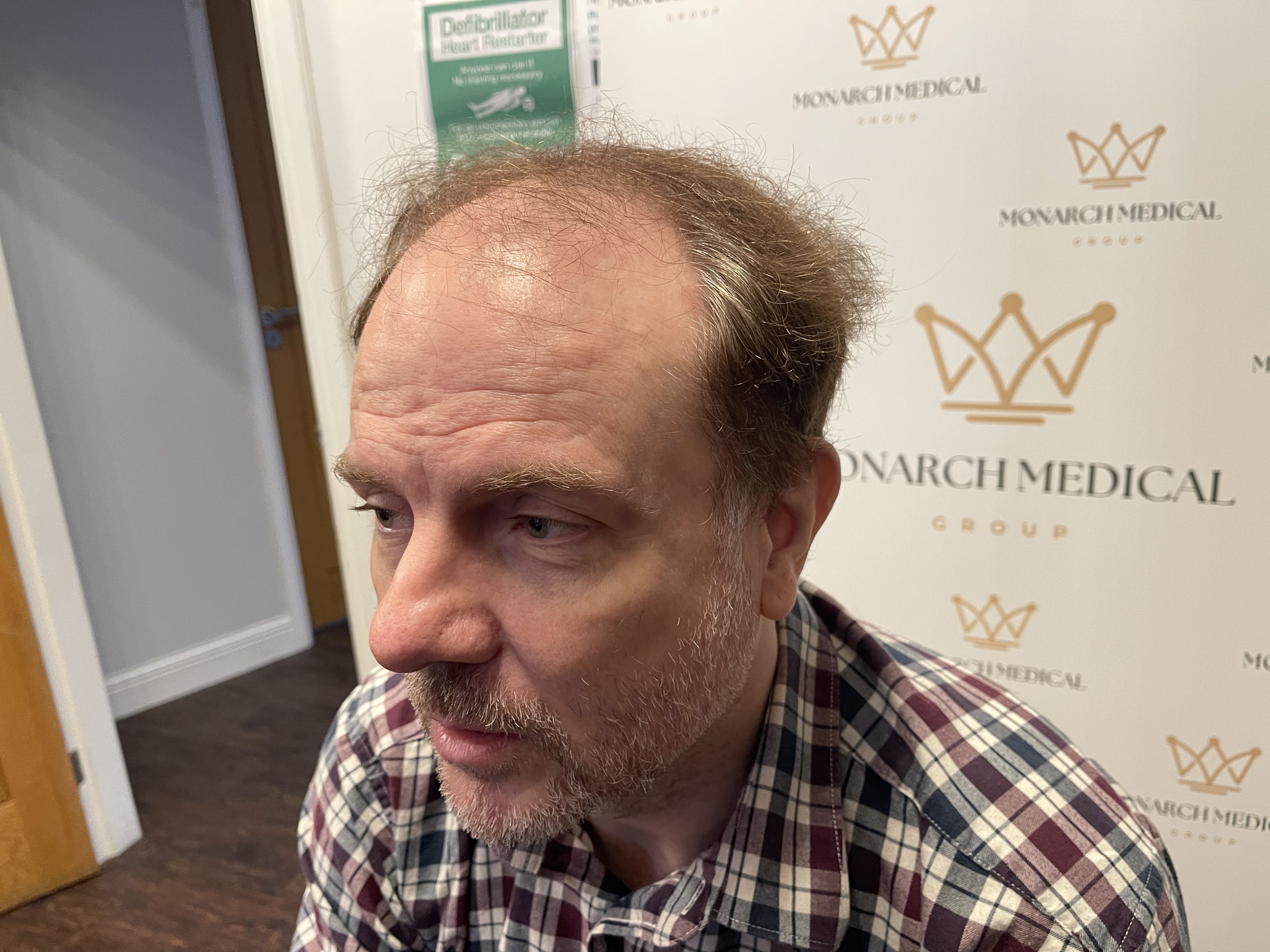 Full scalp hair restoration result photo 6