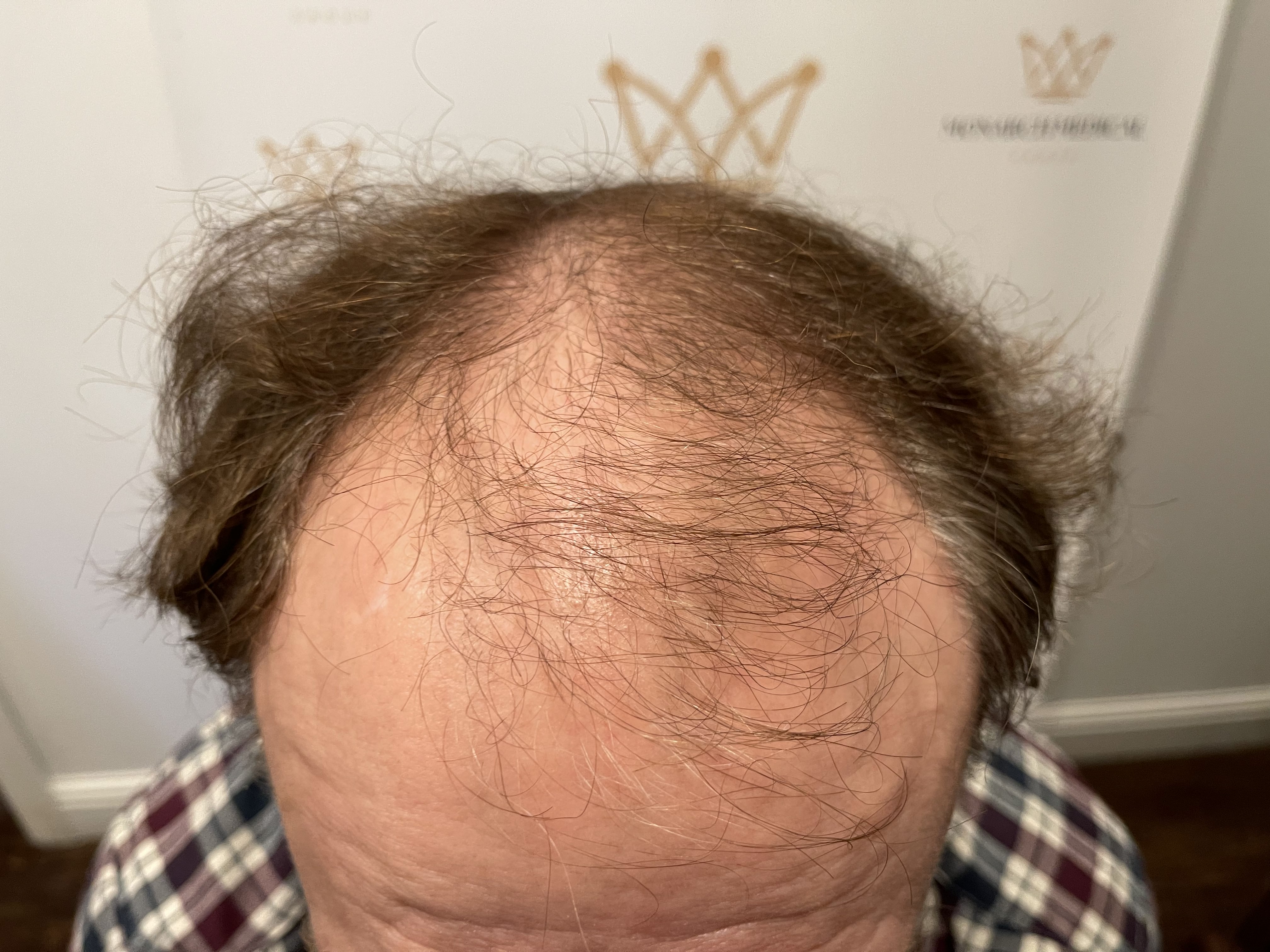 Full scalp hair restoration result photo 7