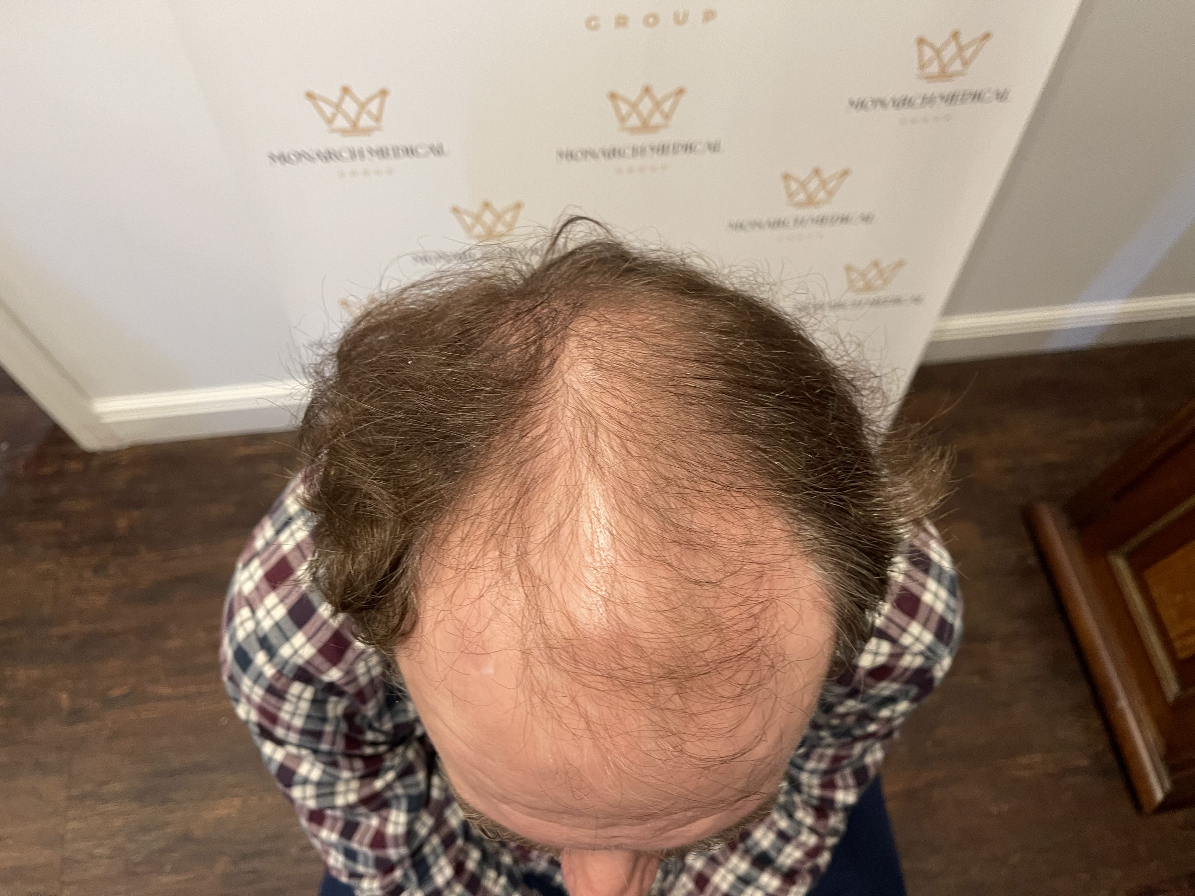 Full scalp hair restoration result photo 8
