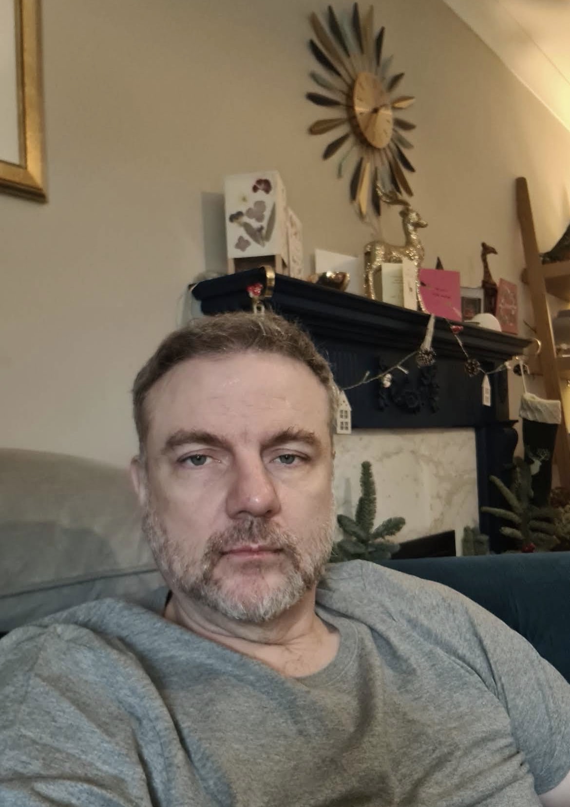 Full scalp hair restoration result photo 9