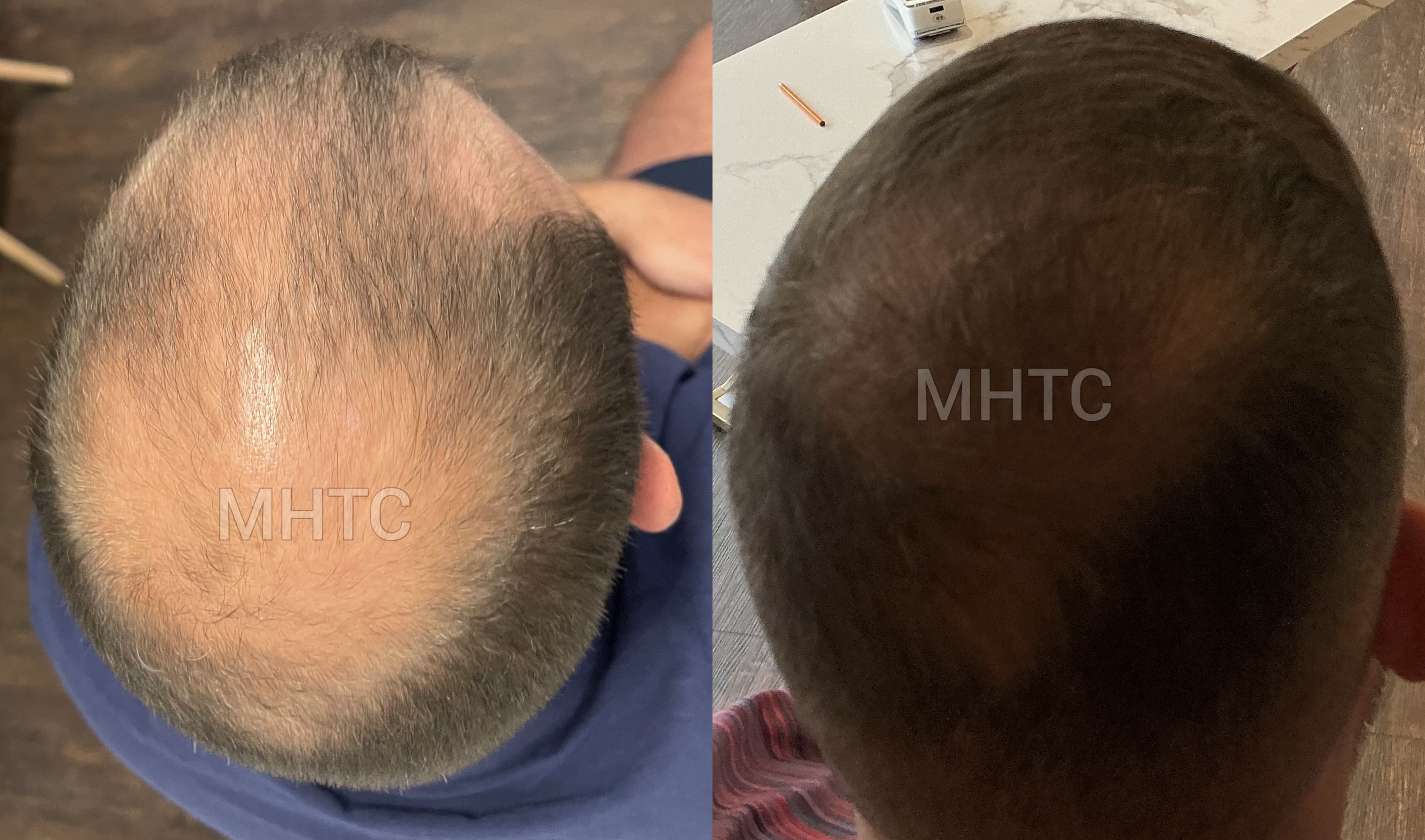 Lewis two-day hair transplant result photo 1