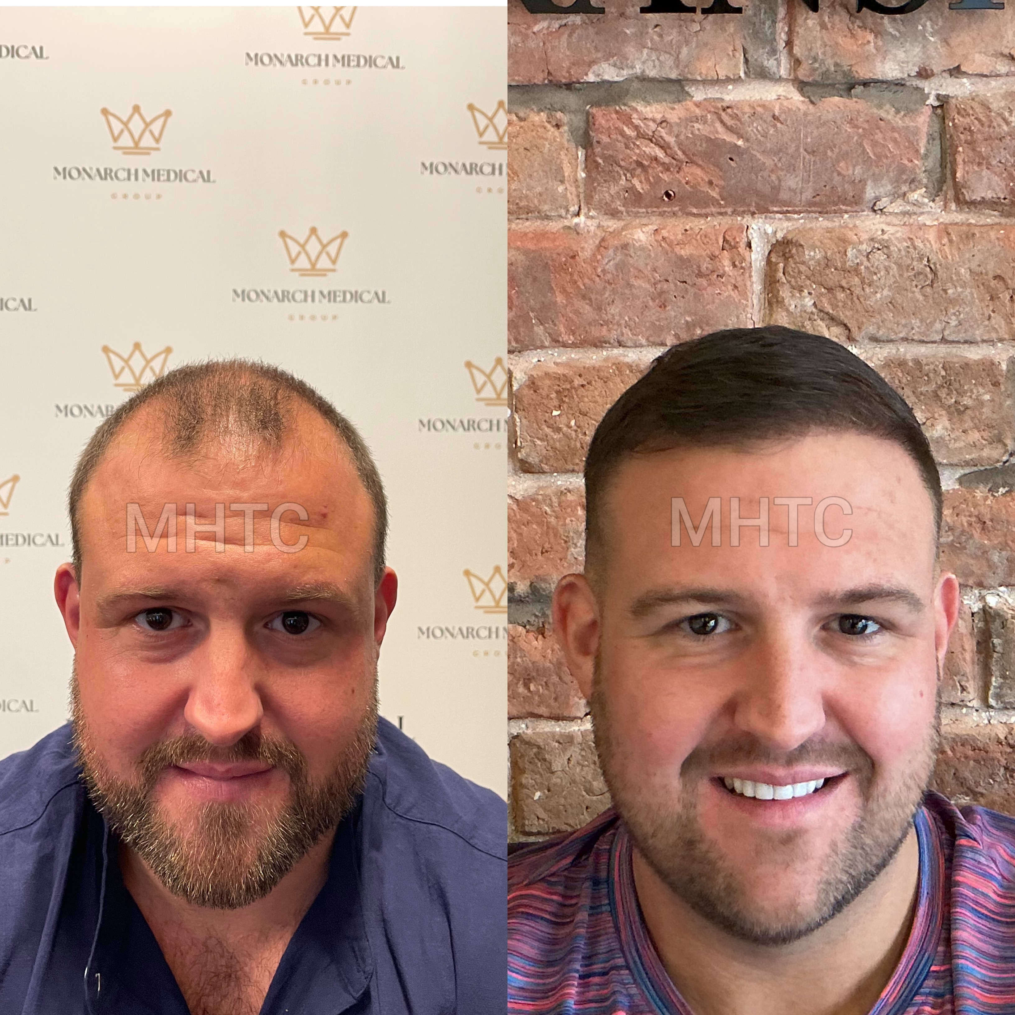 Lewis two-day hair transplant result photo 2