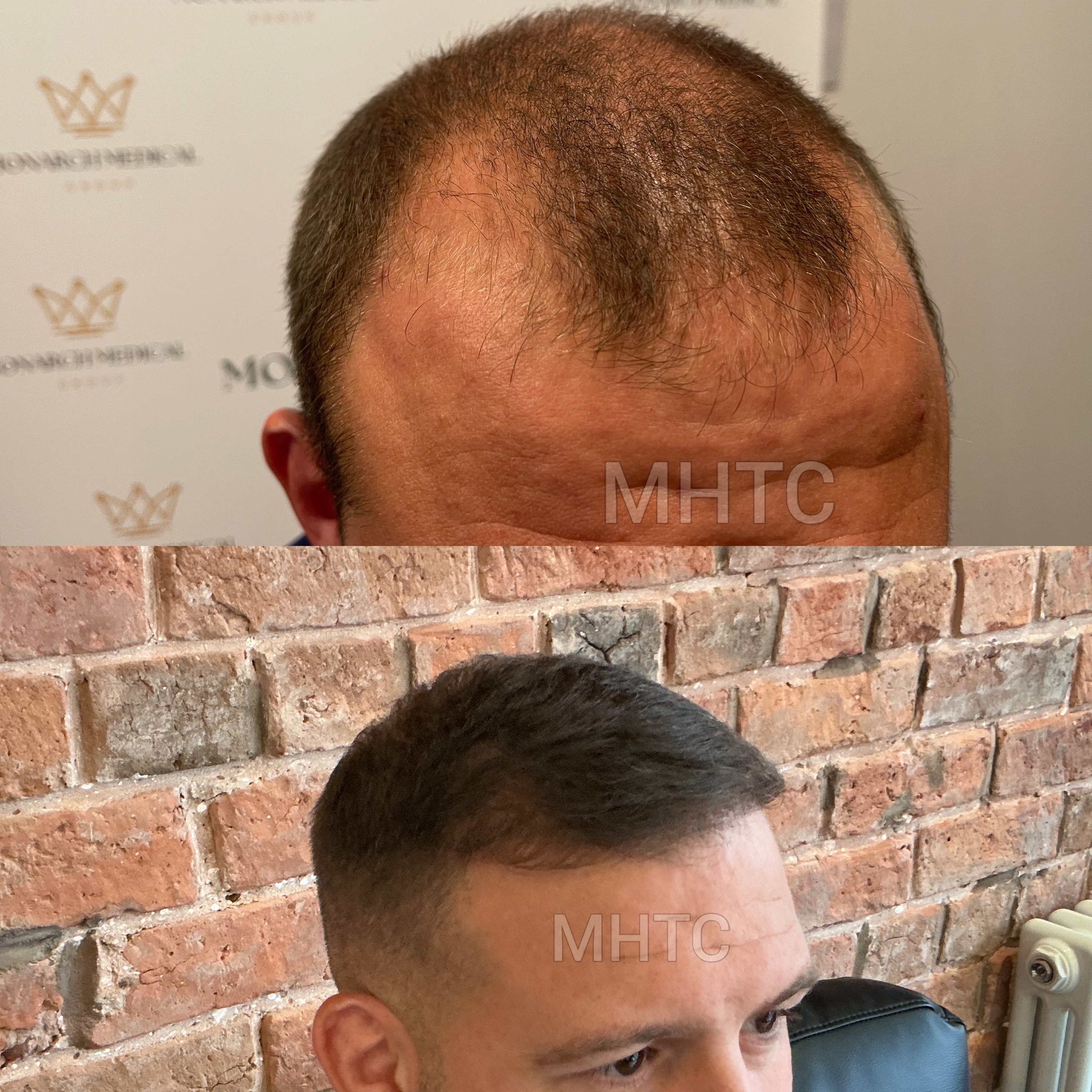 Lewis two-day hair transplant result photo 3