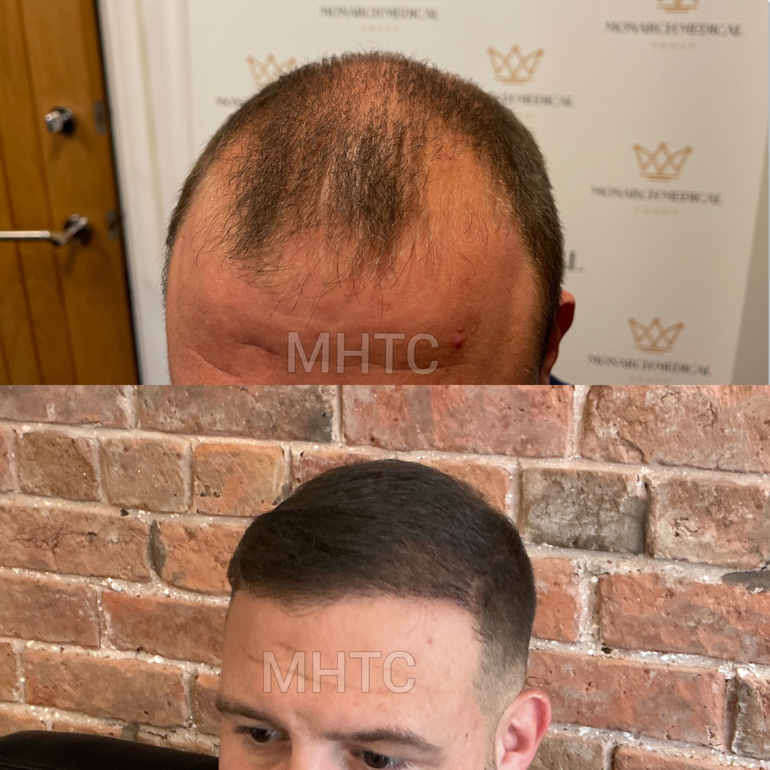Lewis two-day hair transplant result photo 4