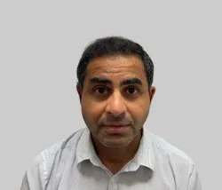 After DHI hair transplant results Chester Cheshire - Patient 2 hairline restoration