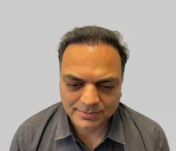 After FUE hair transplant results Chester - Patient 3 crown restoration