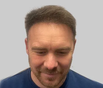 After FUE hair transplant Chester Cheshire - Patient 7 natural hairline results
