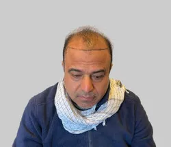 Before FUE hair transplant Chester Cheshire - Patient 1 front view