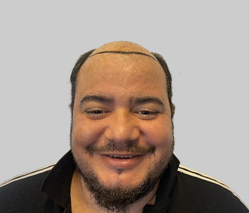 Before FUE hair transplant Chester UK - Ali hair loss