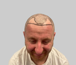 Before hair restoration Chester Cheshire - Patient 4 receding hairline