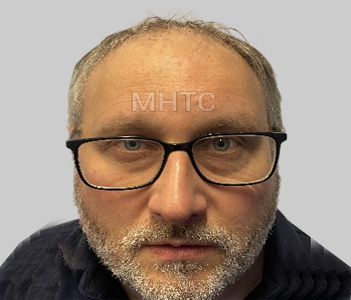 Before DHI hair restoration Chester Cheshire - Patient 9 frontal hair loss