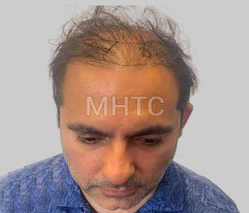 Before DHI hair restoration Chester Cheshire - Patient 6 thinning hair