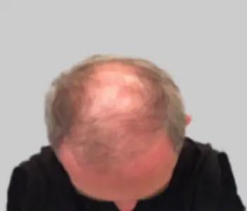 Before FUE hair transplant Chester Cheshire UK - Patient 10 extensive hair loss